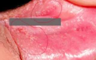 Папилломы на половых губах: фото, локализация, способы удаления