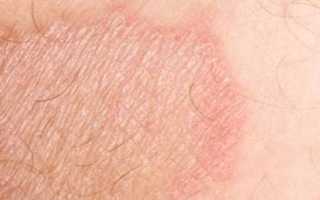 Шелушение кожи в паху у женщин: фото, причины, возможные болезни