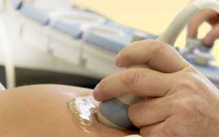 Все, что нужно знать о холестатическом гепатозе беременных