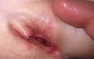 Сыпь на половых губах у женщин: фото, возможные болезни, лечение