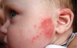 Вакцинация детям от гепатита в