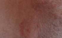 Шелушение кожи на лобке у женщин: после бритья, шугаринга или нового белья